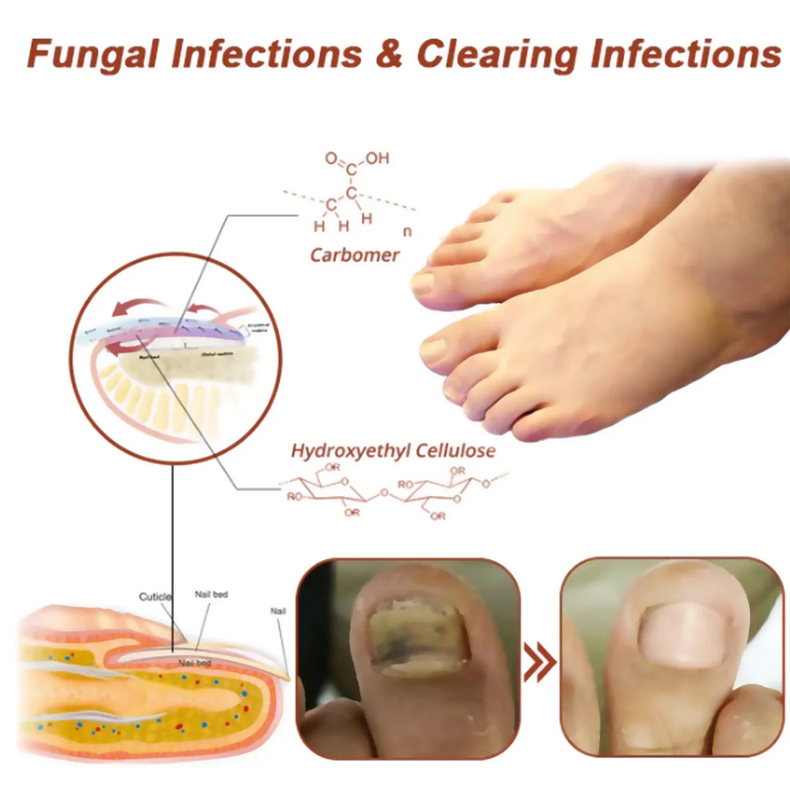 Fungal Nail Laser Device Repair Fast Nails Fungus Onychomycosis